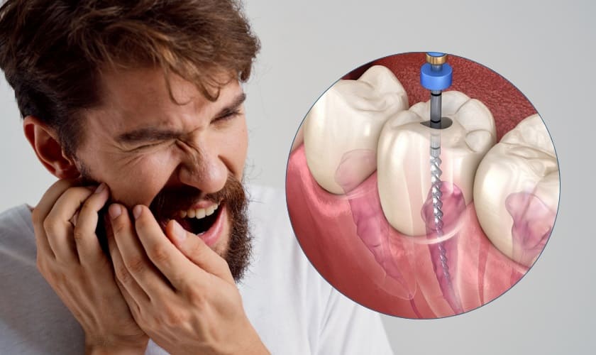 Root Canal Therapy